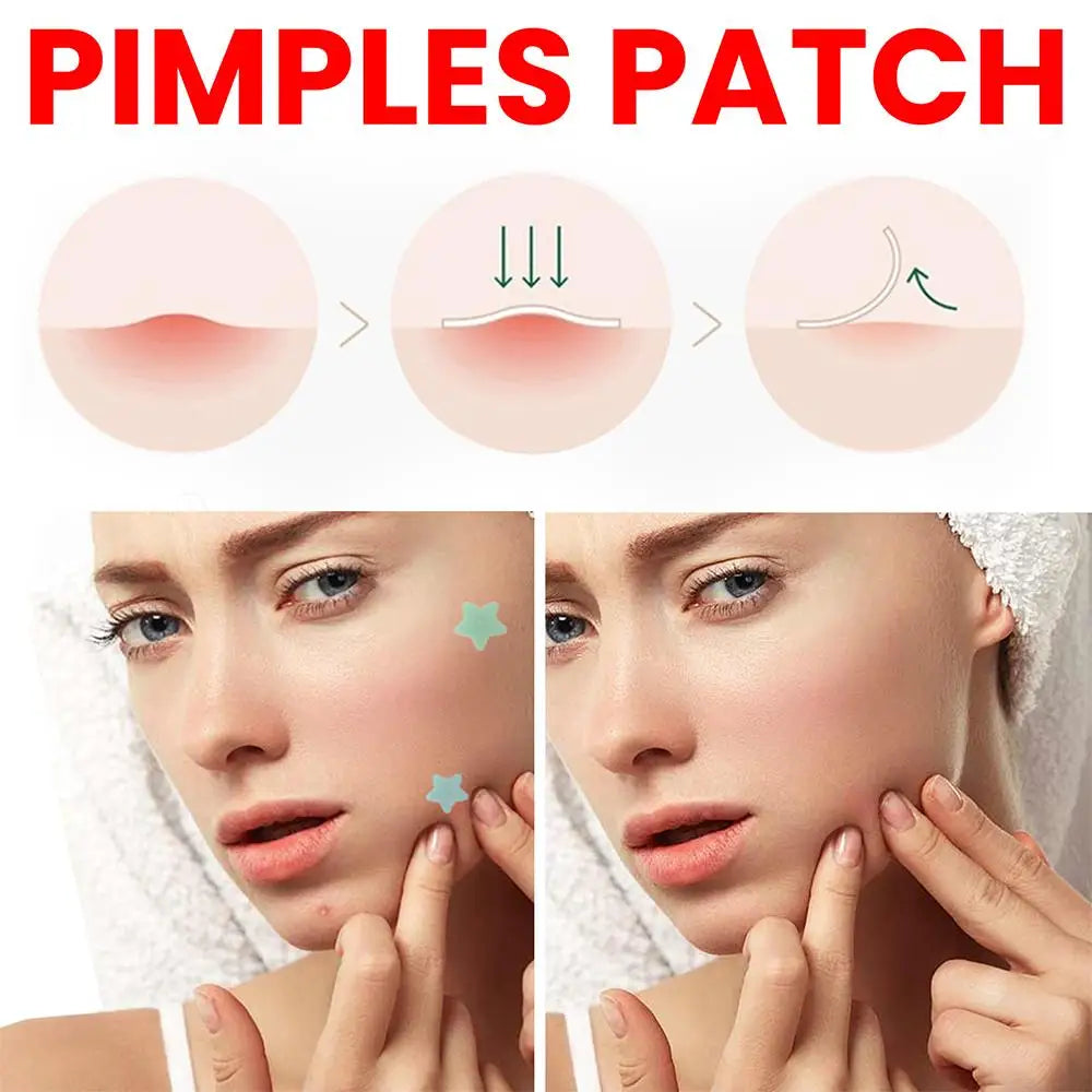 200pcs Star Pimple Patch Acne Invisible Acne Removal Stickers Originality Concealer Face Spot Beauty Skin Care Makeup Tools